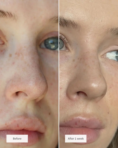 Clinclii™ Hydrocolloid Nose Patches