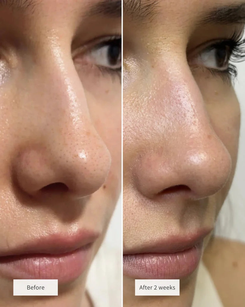 Clinclii™ Hydrocolloid Nose Patches