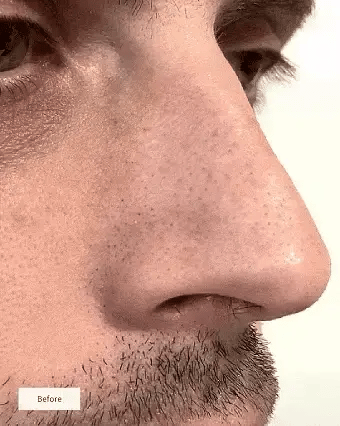 Clinclii™ Hydrocolloid Nose Patches